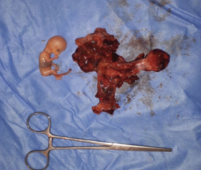 Thirty-seven-year-old female with ruptured ectopic pregnancy