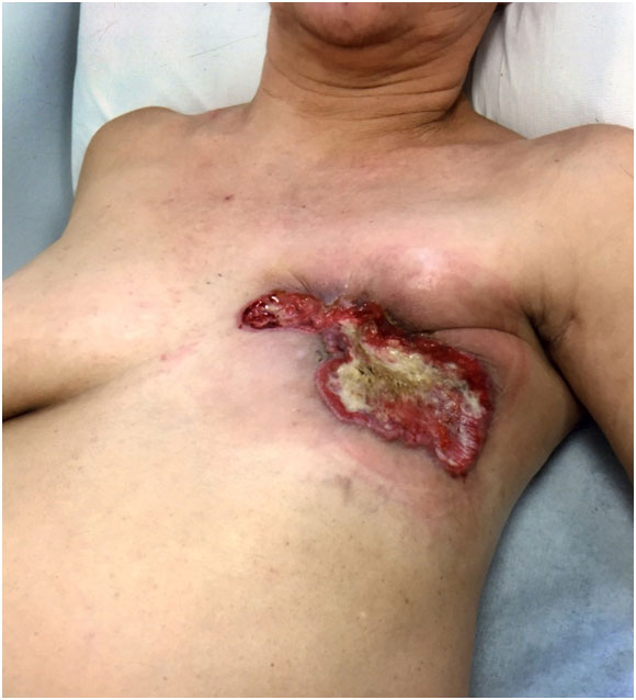 A 32-year-old woman with right breast scar from surgery of cyst