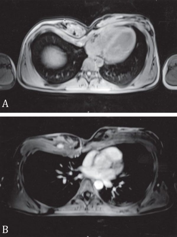 Surgery of congenital breast asymmetry—which objective parameter