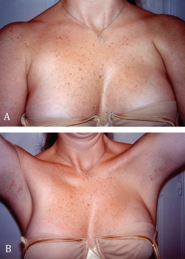 Poland syndrome: Chest wall and breast repair –