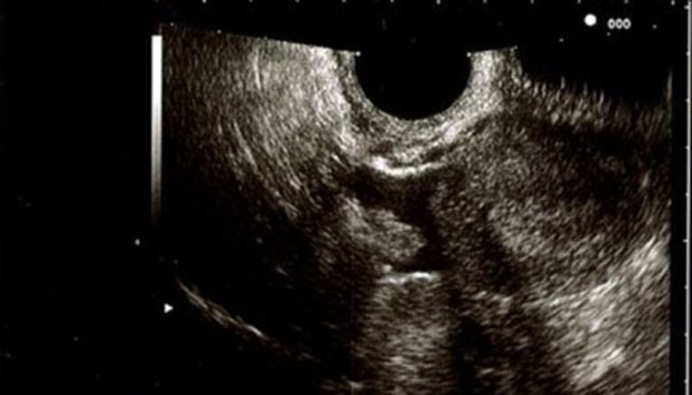 Ovarian torsion during the first trimester of pregnancy: a case report ...