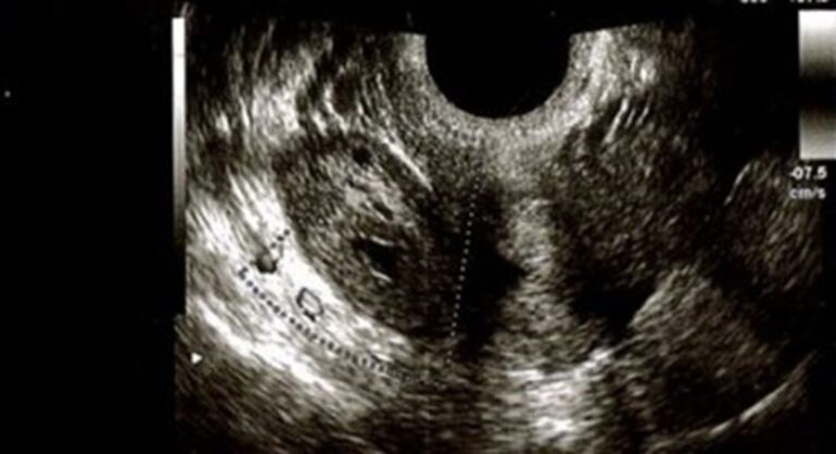 Ovarian torsion during the first trimester of pregnancy: a case report ...